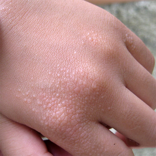Leg rash and Rash in children - Symptom Checker - check ...