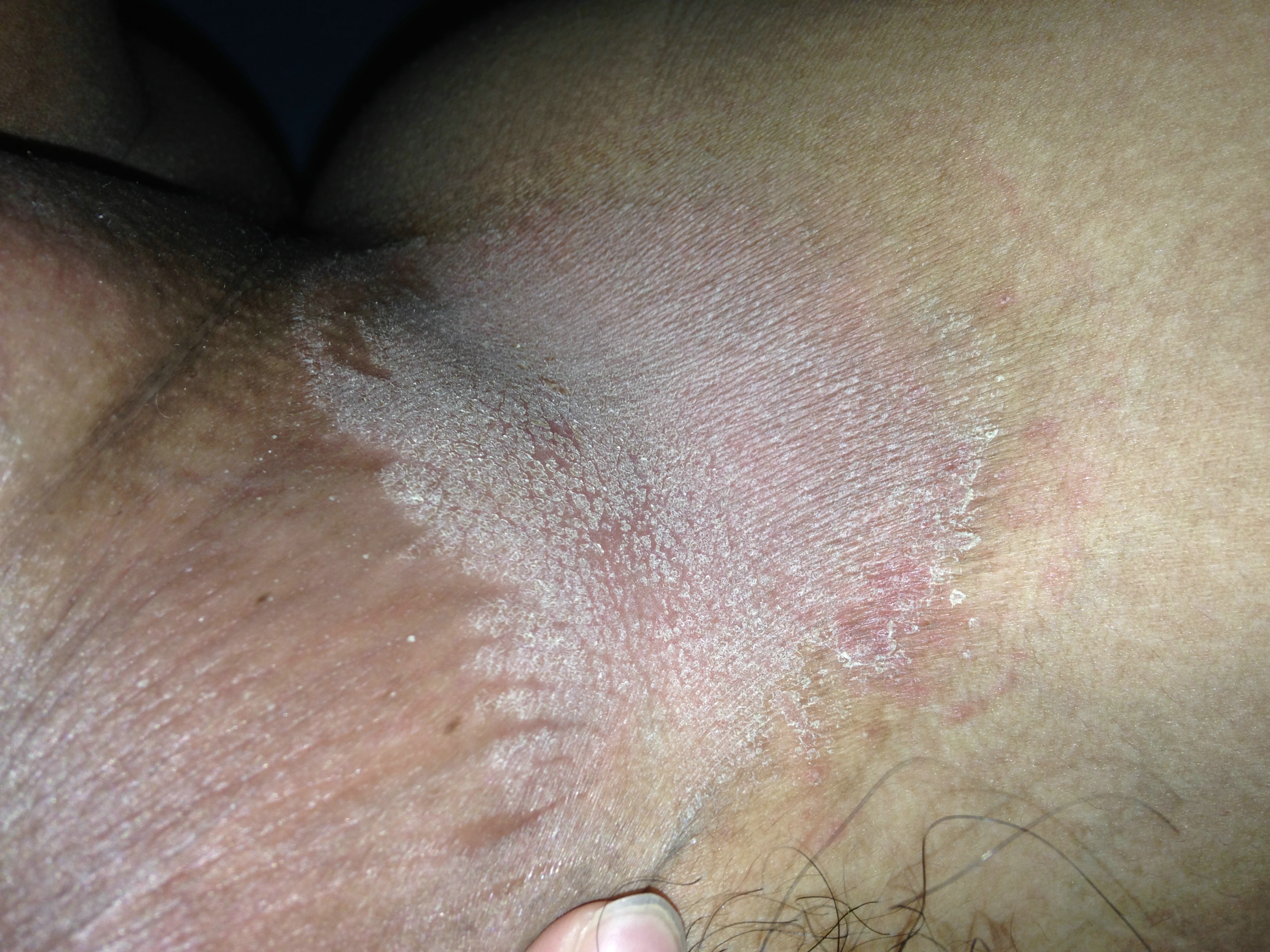 How to Identify an HIV Rash: 15 Steps (with Pictures ...