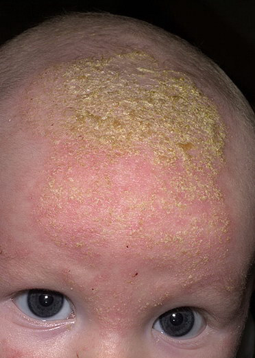 Seborrheic Dermatitis - baby, symptoms, Definition ...