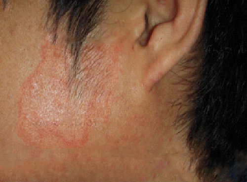 Facial Fungal Rash 99