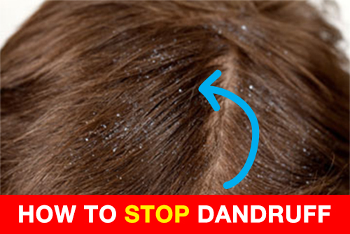 how to get rid of dandruff how to get rid of dandruff in 4 simple steps nizoralshop how to get rid of dandruff how to get rid of dandruff in 4 simple steps nizoralshop