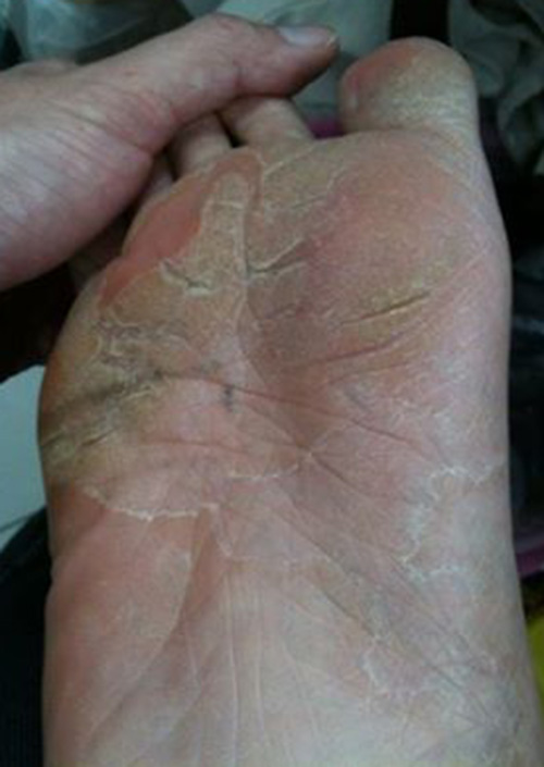 Athlete’s foot (tinea pedis): Pictures, symptoms and treatment