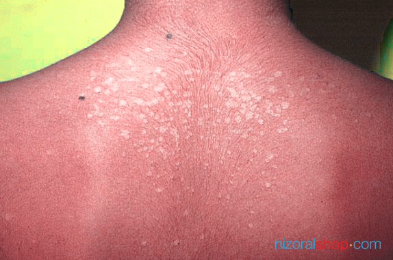 Tinea versicolor: MedlinePlus Medical Encyclopedia