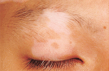 tinea versicolor on face #9