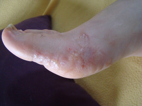 Tinea Pedis â€