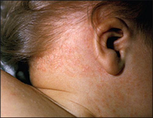 Infant with Seborrheic Eczema around the ear and on the back of the neck and scalp.