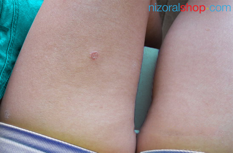 Eczema can appear on the upper legs as red and itchy coin-shaped spots