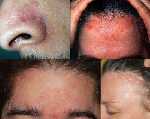 Four types of Eczema and Seborrheic Dermatitis