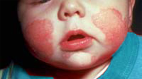 Babies on sale fungal infection