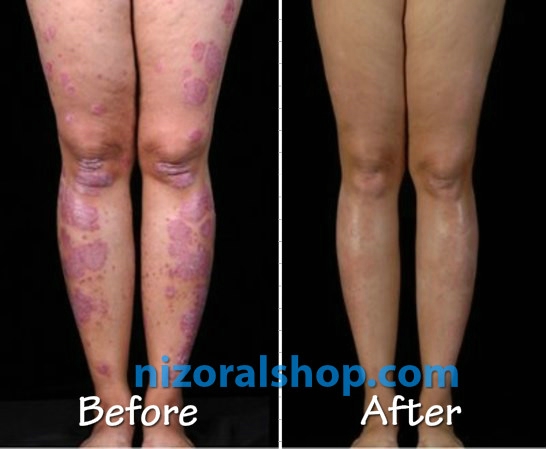 Before After Skin fungal infection treatment