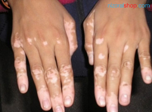 Tinea Versicolor on Hands